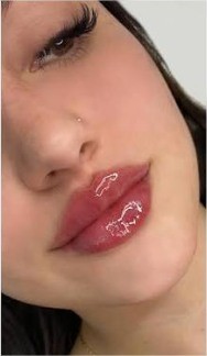 Lip Fillers After